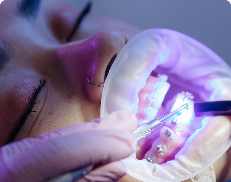Clareamento Dental